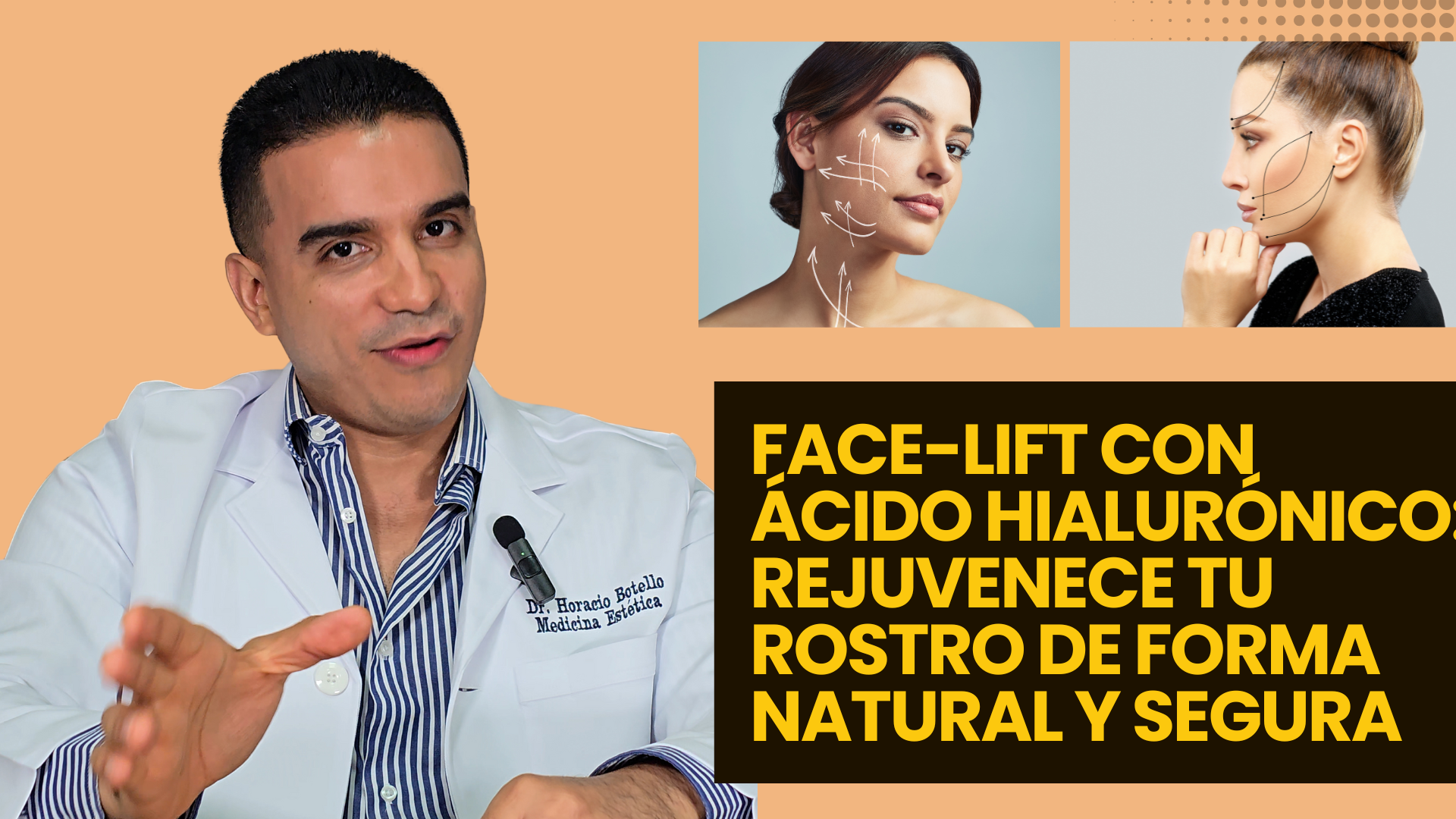 Face-lift con Ácido Hialurónico: Rejuvenece Tu Rostro de Forma Natural y Segura